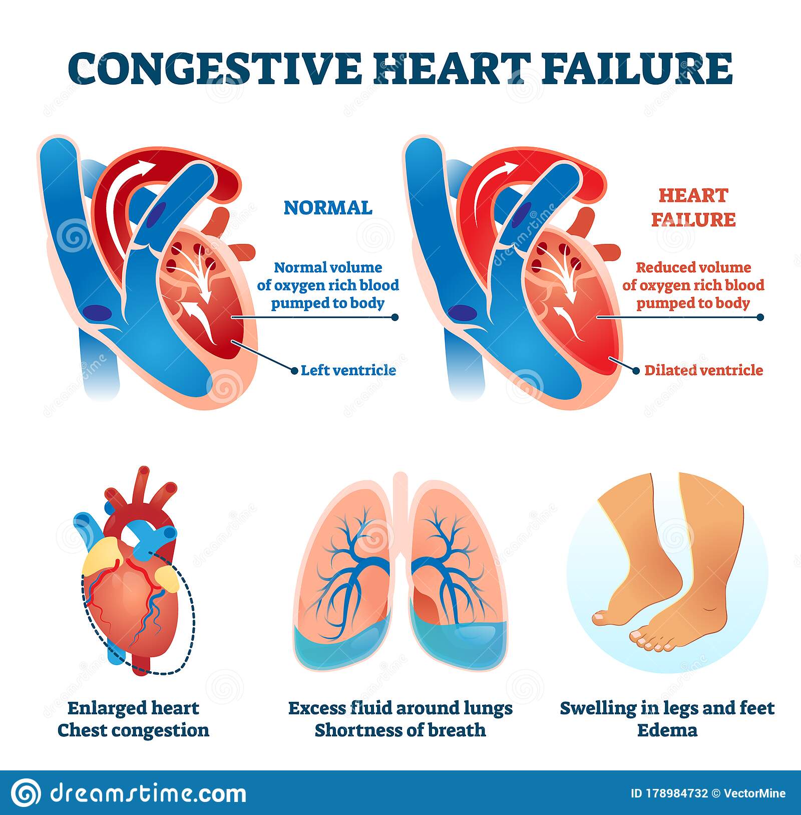 congestive heart failure trong tiếng Anh