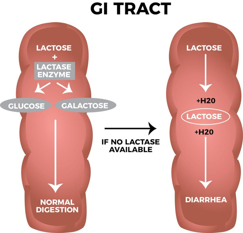 lactose intolerance là gì