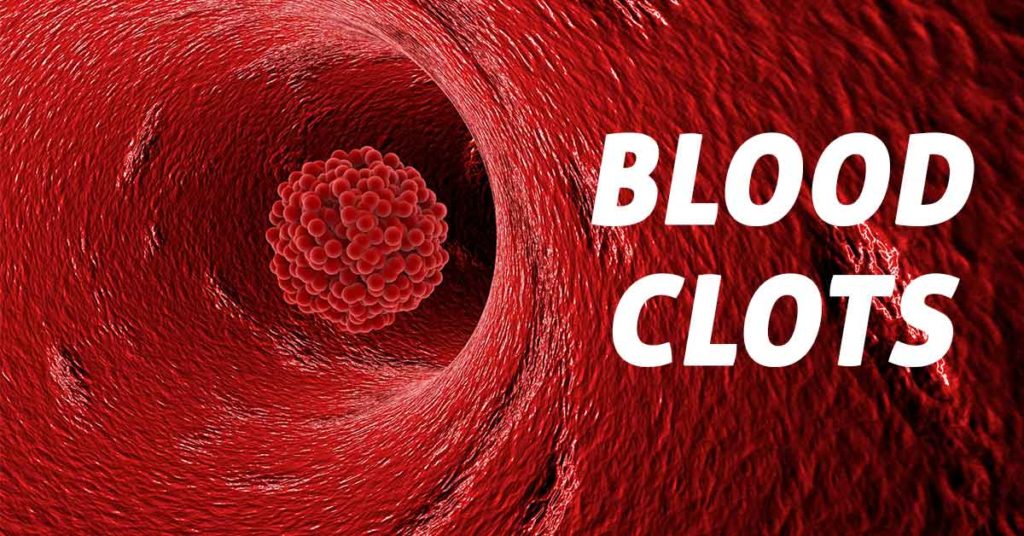 blood clot là gì