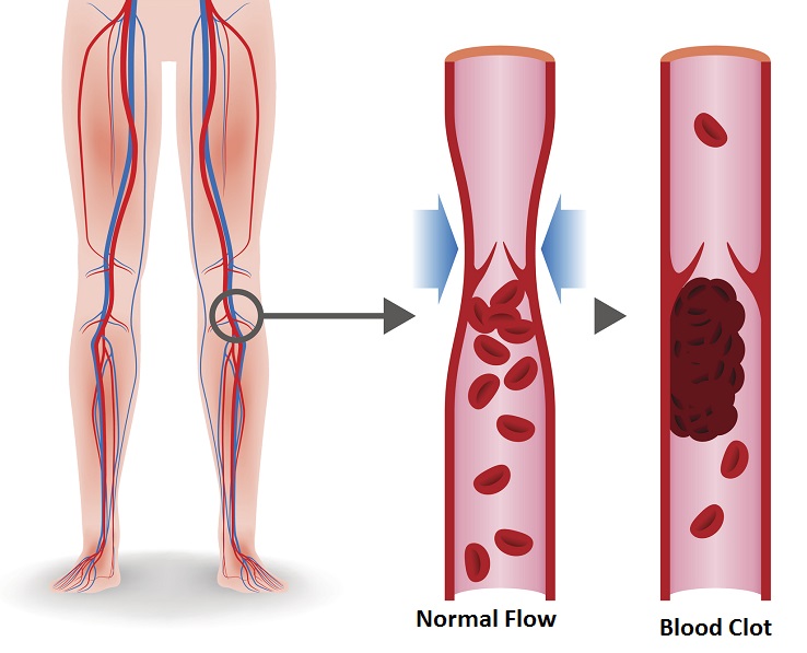 blood clot là gì