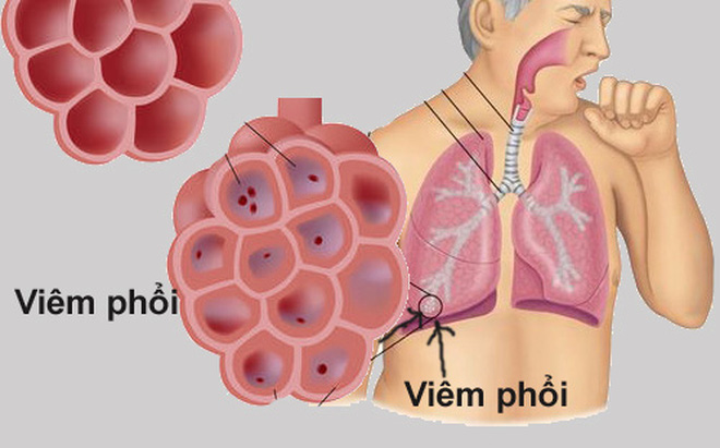 viêm phổi tiếng anh là gì