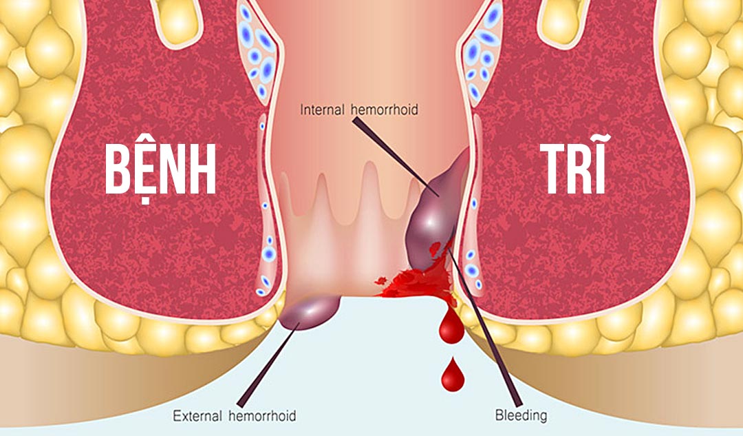 bệnh trĩ tiếng anh là gì