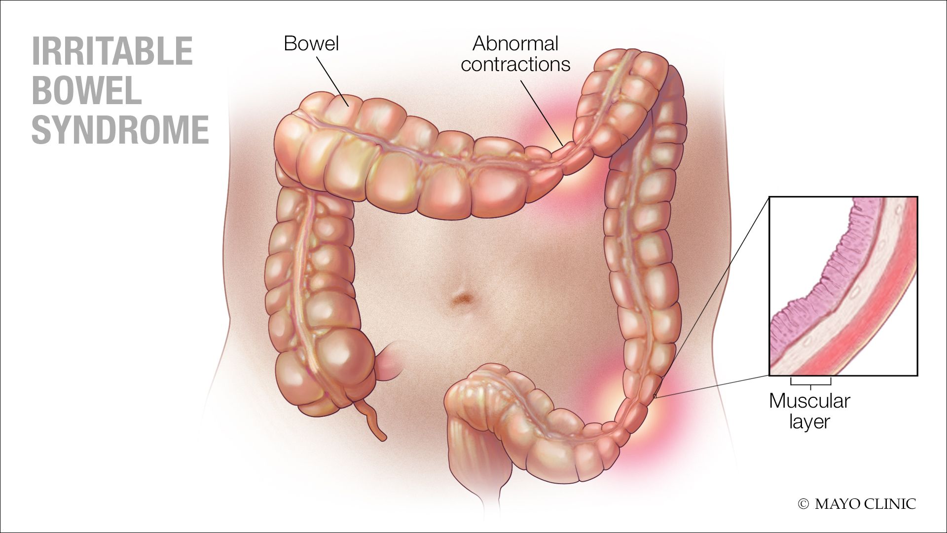bowel là gì