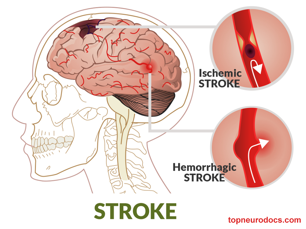 Stroke là gì