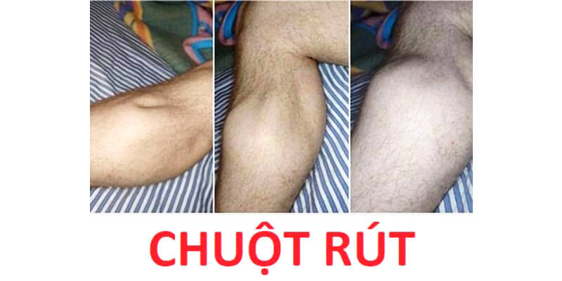 chuột rút tiếng anh là gì