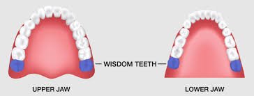 răng khôn tiếng anh là gì