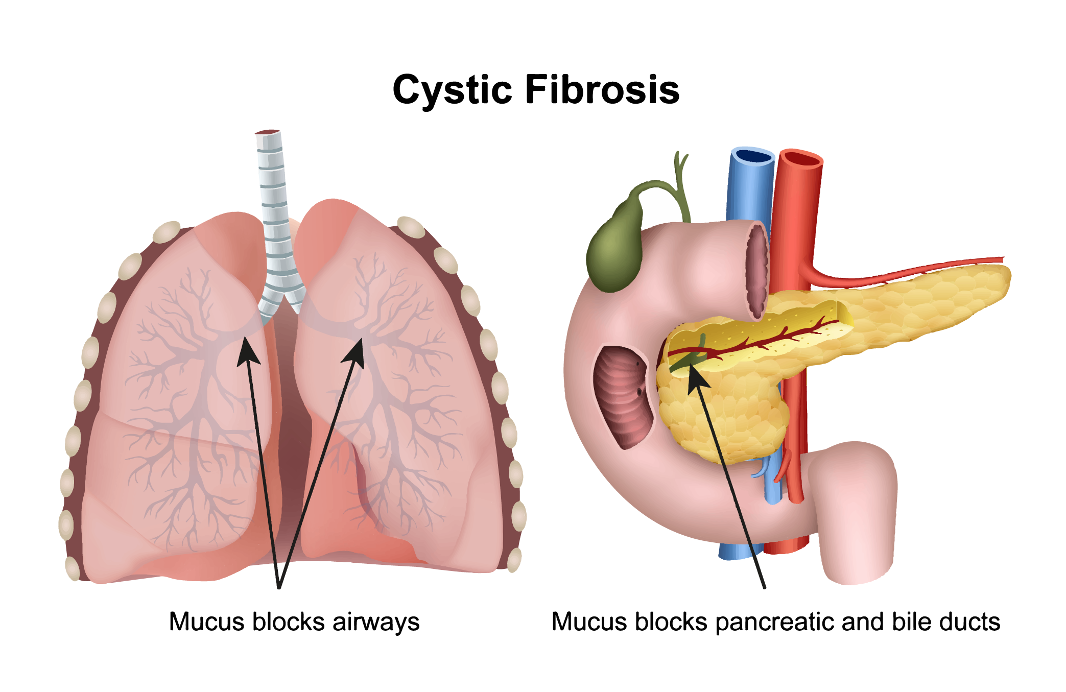 cystic fibrosis là gì