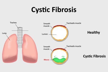 cystic fibrosis là gì