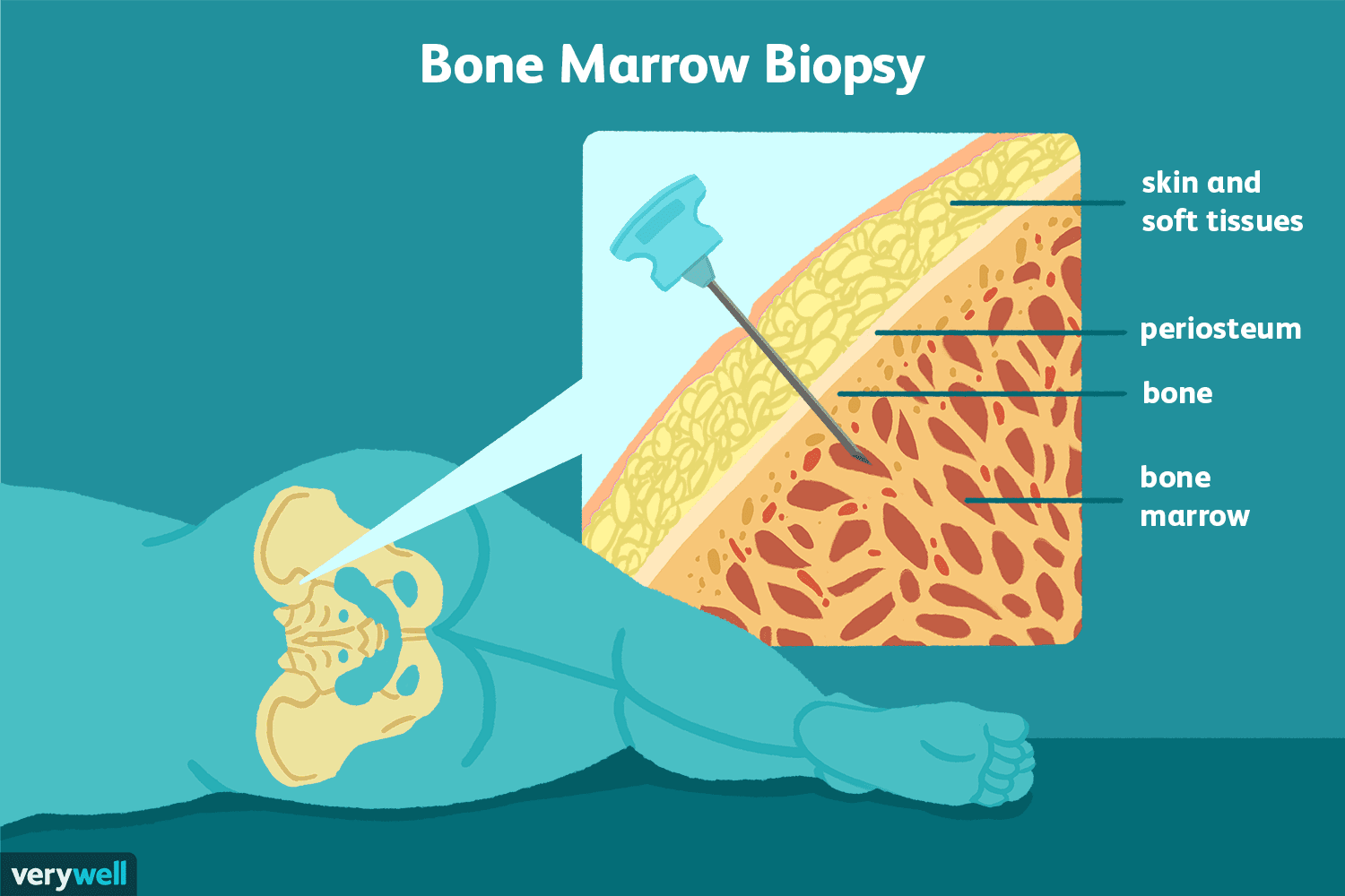 bone marrow là gì